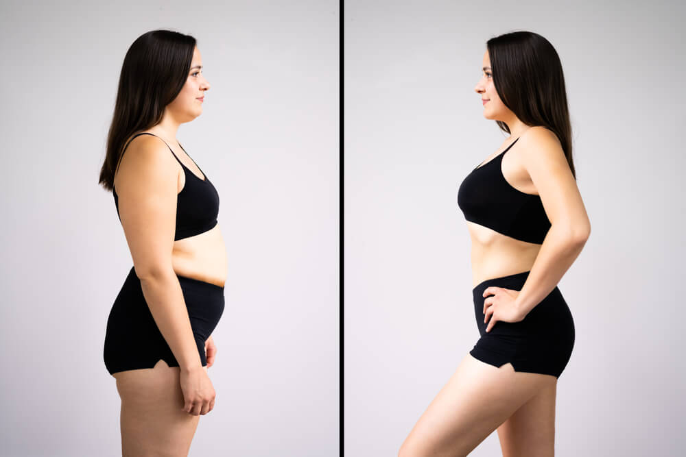 Abdominoplastika – Dovedite izgled svog stomaka do savršenstva!