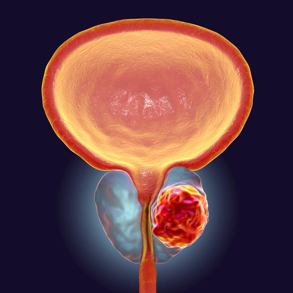 Karcinom prostate