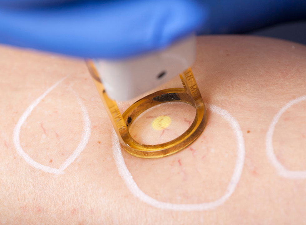 Zakažite Lasersko Uklanjanje Kapilara I Hemangioma