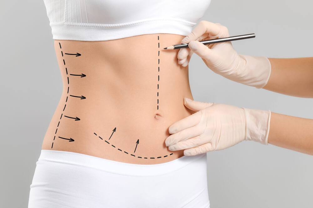 Abdominoplastika