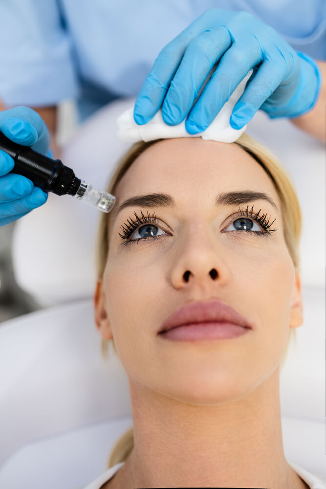 Microneedling tretman